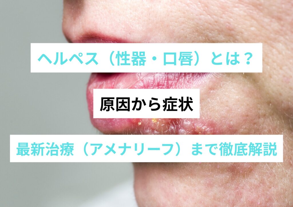 【医師監修】ヘルペス(性器・口唇)とは?原因から症状、最新治療(アメナリーフ)まで徹底解説