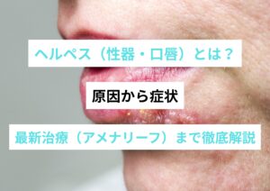 【医師監修】ヘルペス（性器・口唇）とは？原因から症状、最新治療（アメナリーフ）まで徹底解説