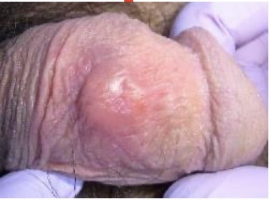 梅毒（第1期）による硬いしこりの症例写真